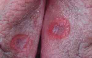 Сифіліс на статевих губах: симптоми, лікування і наслідки