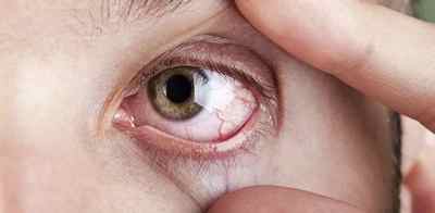Сифіліс очі: симптоми і ознаки.