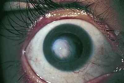 Сифіліс очі: симптоми і ознаки.