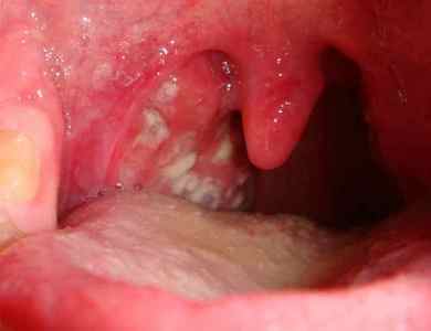 Сифіліс у роті: причини, симптоми, лікування, діагностика