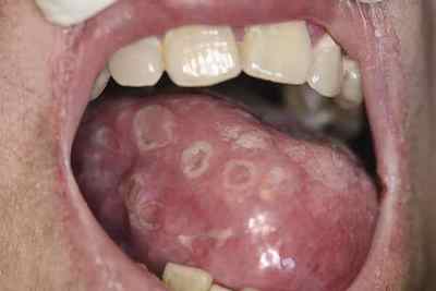 Сифіліс у роті: симптоми і лікування.