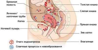 Симптоматика і основні методи лікування ендометріозу у жінок