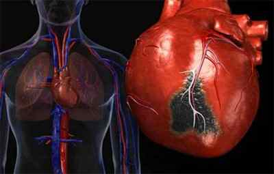 Симптоми абдомінальної форми інфаркту міокарда і як надати першу допомогу хворому