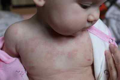 Симптоми алергічного дерматиту у дітей - фото