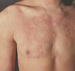 Симптоми алергії на хлор