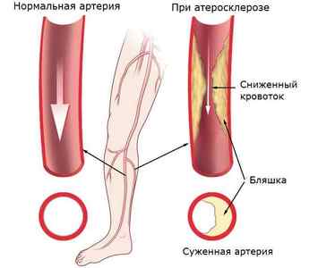 Симптоми атеросклерозу судин нижніх кінцівок і методи лікування