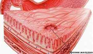 Симптоми ерозії шлунка: клінічна картина захворювання, його діагностика