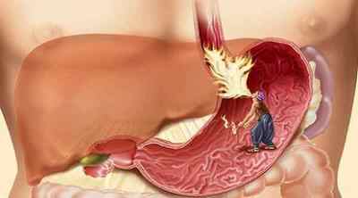 Симптоми ерозії шлунка: клінічна картина захворювання, його діагностика