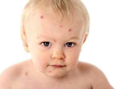 Симптоми і фото харчової алергії у дітей