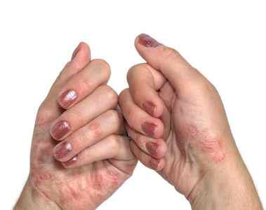 Симптоми і фото початковій стадії псоріазу на руках. Чим лікувати захворювання?