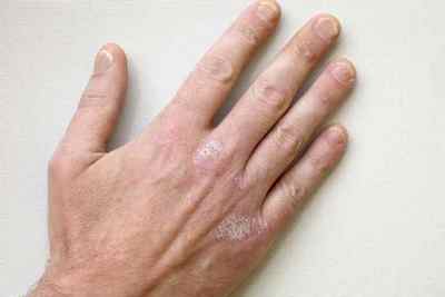 Симптоми і фото початковій стадії псоріазу на руках. Чим лікувати захворювання?