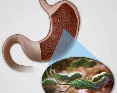 Симптоми гастриту з підвищеною кислотністю шлунка: як розпізнати хворобу