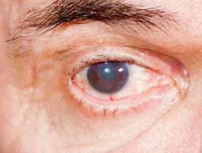 Симптоми глаукоми очі: ознаки на ранніх стадіях, діагностика у дорослих, як виявляється