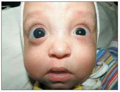 Симптоми глаукоми очі: ознаки на ранніх стадіях, діагностика у дорослих, як виявляється