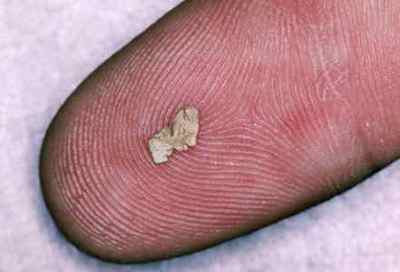 Симптоми хвороби нирок у чоловіків: ознаки патологій і лікування