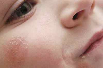 Симптоми контактного дерматиту - лікування і фото