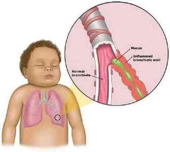 Симптоми і лікування бронхіту у дітей - як розпізнати і вилікувати хворобу