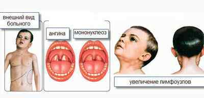 Симптоми і лікування мононуклеозу у дітей по Комаровскому