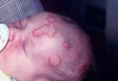 Симптоми і лікування рожевого лишаю у дітей (фото)