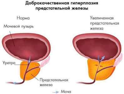 Симптоми і лікування сечокамяної хвороби у чоловіків