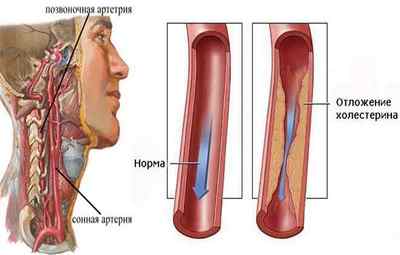 Симптоми і лікування стенозу сонної артерії