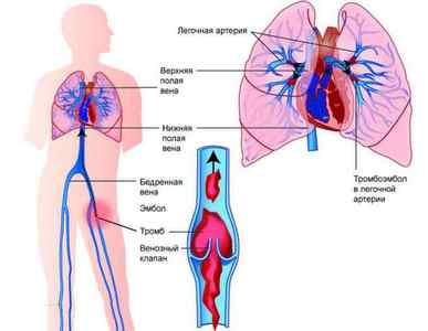 Симптоми і лікування тромбоемболії легеневої артерії