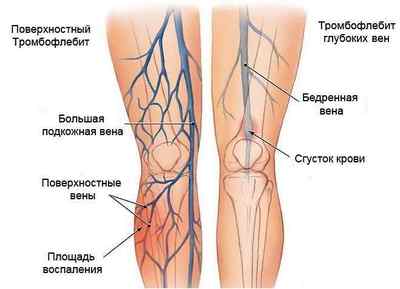 Симптоми і лікування тромбофлебіту нижніх кінцівок