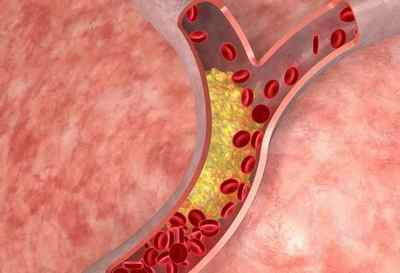 Симптоми і лікування тромбозу стегнової артерії