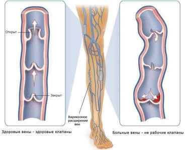 Симптоми і лікування тромбу в нозі
