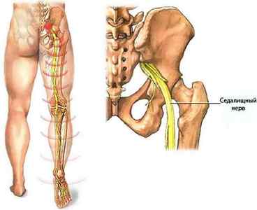 Симптоми і лікування защемлення нерва в нозі