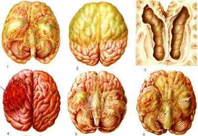 Симптоми і наслідки нейроінфекції мозку, її код за МКХ-10