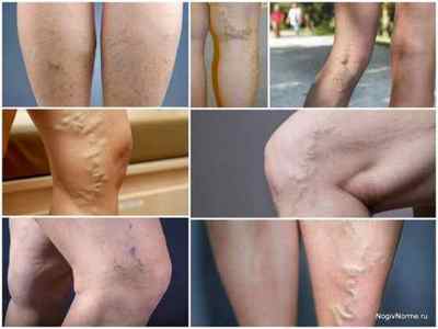 Симптоми і ознаки варикозного розширення вен на ногах