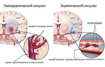 Симптоми і перші ознаки інсульту