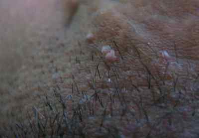 Симптоми появи бородавок на статевих губах, в піхву, в паху, на лобку і шийці матки. Вид недуги на фото