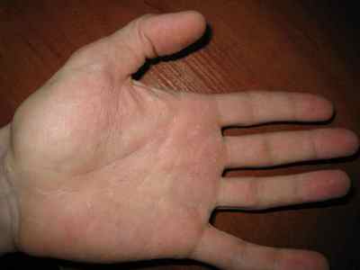 Симптоми і причини появи псоріазу на долонях рук з фото, а так само методи лікування