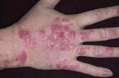 Симптоми і причини появи псоріазу на долонях рук з фото, а так само методи лікування