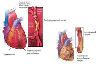 Симптоми і причини тромбу в серці
