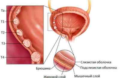 Симптоми раку сечового міхура у жінок і чоловіків
