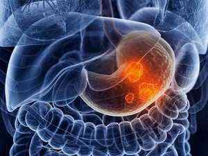 Симптоми раку шлунка: як проявляються злоякісні новоутворення