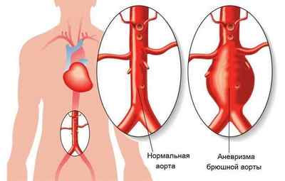 Симптоми тромбозу черевної аорти та способи його лікування