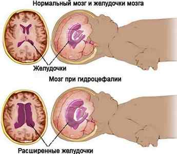 Симптоми і види гідроцефалії головного мозку у дітей