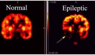 Симптоми виникнення нападу епілепсії і її лікування