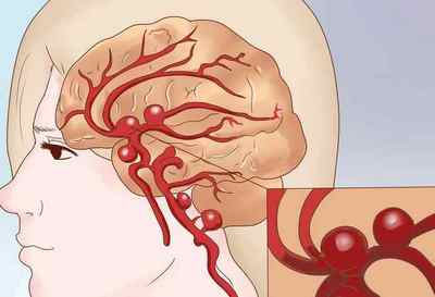 Симптоми закупорки судин головного мозку