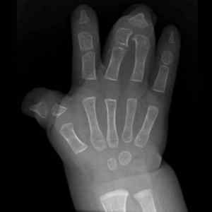 Синдактилія пальців ніг і рук: що це, причини зрощення пальців стопи | Ревматолог