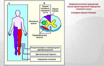 Синдром Броун-Секара: неврологія і механізми виникнення, симптоми і лікування | Ревматолог