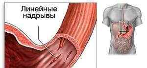 Синдром Бурхаве: що це, причини, симптоми. Як лікується перфорація стравоходу