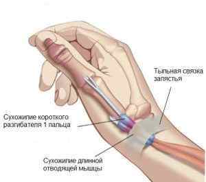 Синдром Де Кервена: лікування запалення звязок і сухожиль, сухожилля великого пальця руки, який лікар лікує | Ревматолог