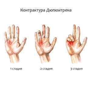 Синдром Дюпюїтрена: причини виникнення шишок на долонях, стягує сухожилля рук, контрактура, як відновити функції кисті | Ревматолог