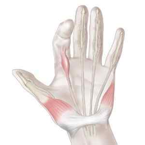 Синдром Дюпюїтрена: причини виникнення шишок на долонях, стягує сухожилля рук, контрактура, як відновити функції кисті | Ревматолог