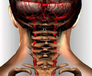 Синдром хребетної артерії при шийному остеохондрозі: симптоми і лікування | Ревматолог